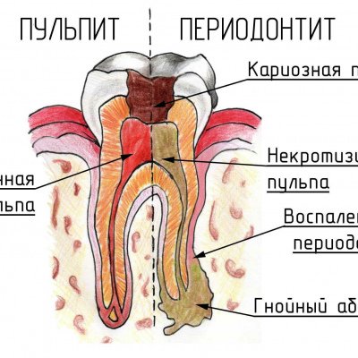 Лечения гнойного периодонтита у женщины