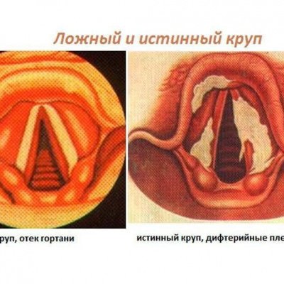 Круп лечение гомеопатией