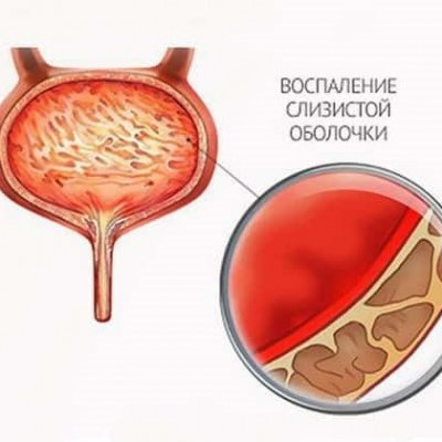 Лечение цистита у детей гомеопатией