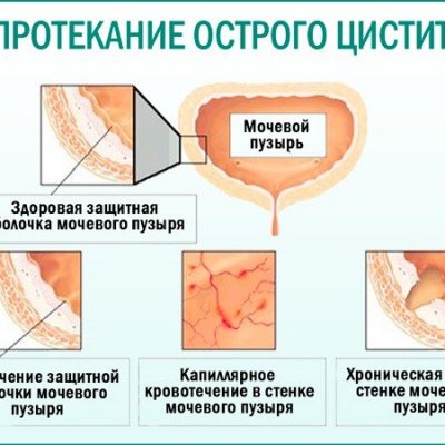 Цистит у женщин лечение с помощью гомеопатии