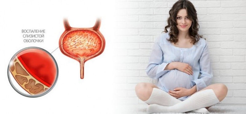 Цистит у беременных и как его лечить гомеопатией