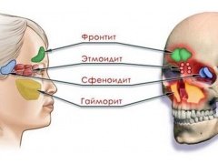 Лечение синуситов