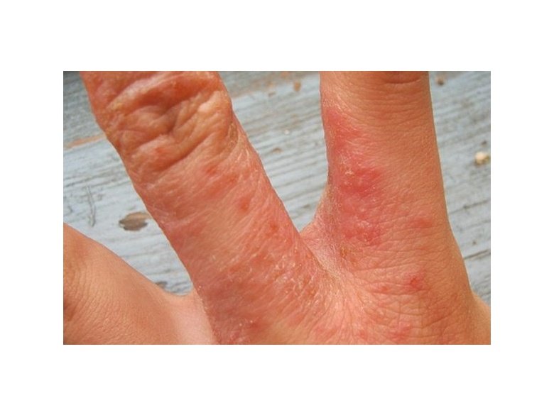 Лечение нейродермита у семилетней девочки. - Клиника С Ганемана