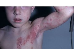 herpes_in_children