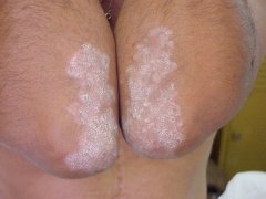 Лечение гомеопатией псориаза кожи у мужчин и женщин