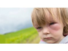 Случай лечения отек Квинке, неотложная гомеопатическая помощь ребенку