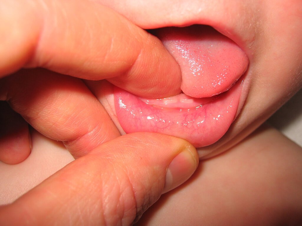 Ребенку 5 лет лезет зуб