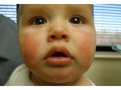 Клинический случай лечение атопического дерматита у мальчика
