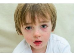Случай лечения гомеопатией стрептококкового импетиго у ребенка 8 лет
