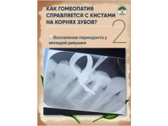 Клинические случаи кисты на корнях зубов, лечение с помощью гомеопатии