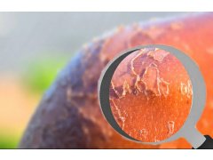 Солнечные ожоги: виды, последствия и особенности лечения